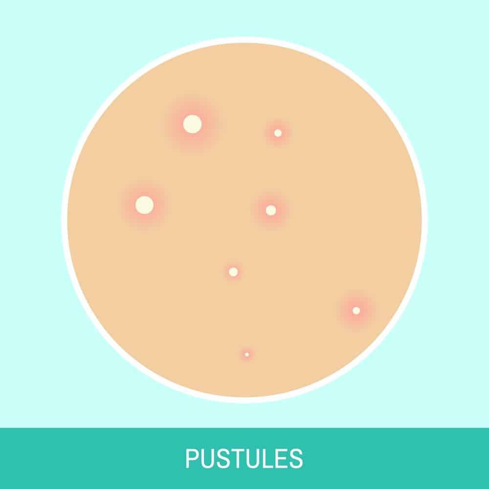 Mụn đinh râu có nguy hiểm không? Điều trị thế nào?