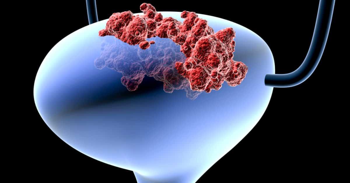 Ung thư bàng quang giai đoạn đầu