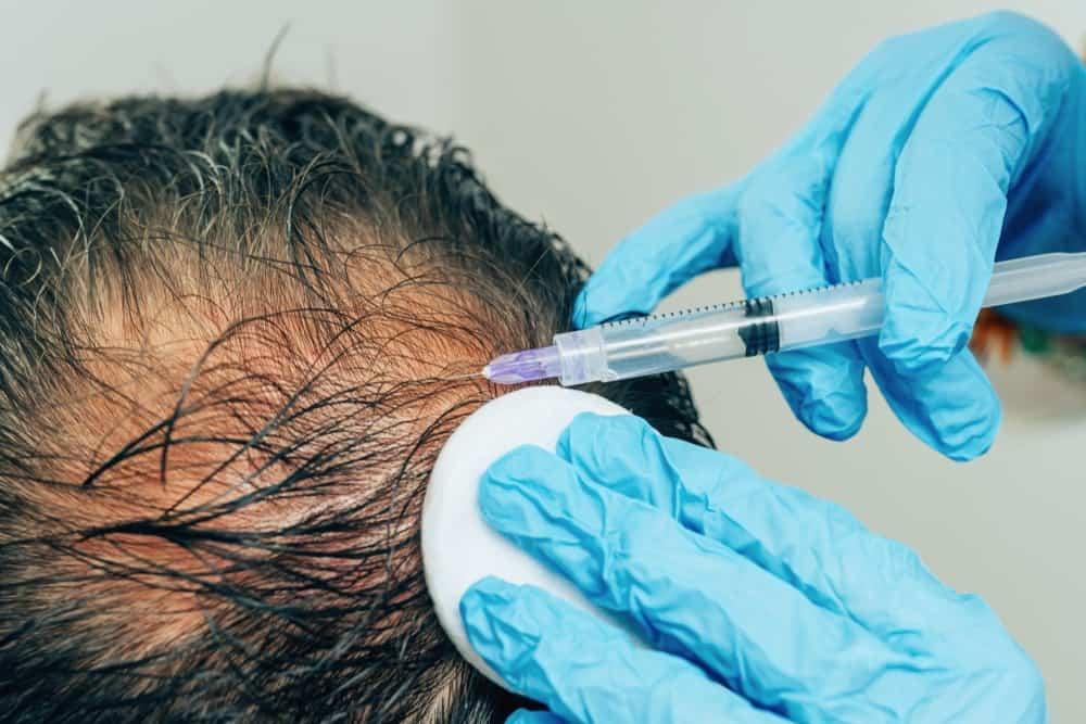 Điều trị rụng tóc bằng phương pháp PRP