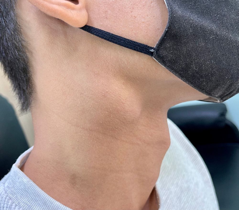 Giải đáp lao hạch có tái phát không?