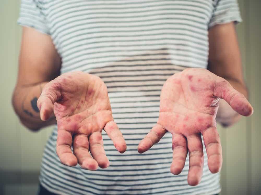 Nốt thủy đậu bị nhiễm trùng có nguy hiểm không? Xử lý thế nào?