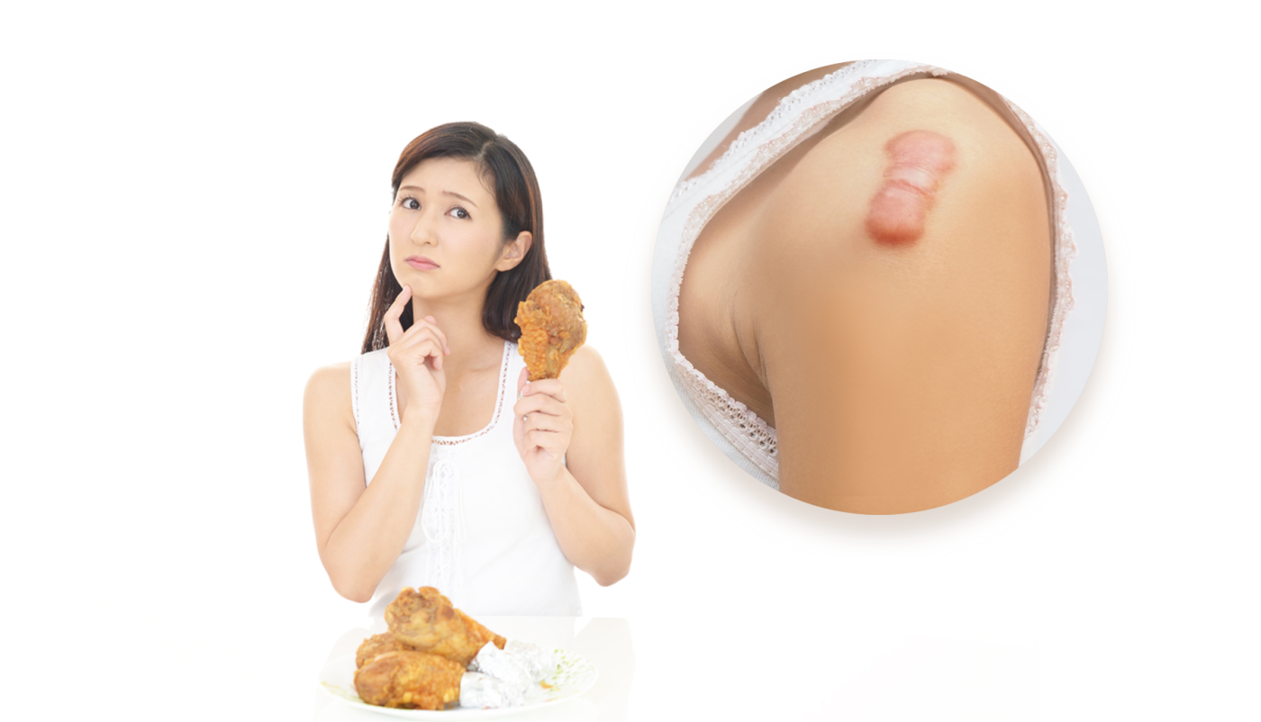 Ăn thịt gà có bị sẹo lồi không? Giải đáp từ góc nhìn khoa học