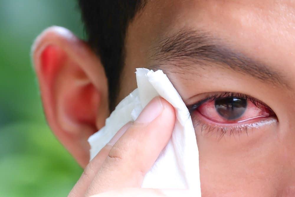 Bệnh viêm kết mạc có lây không?