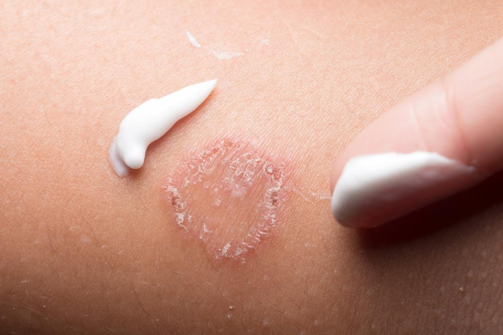 Bị nổi vòng tròn đỏ trên da là bệnh gì?