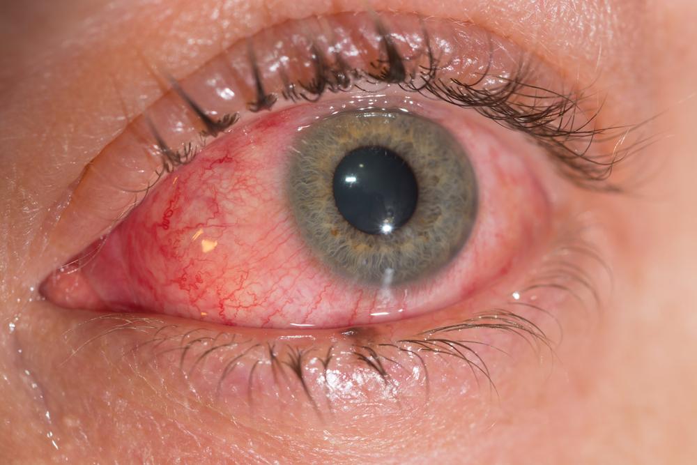 virus-viem-ket-mac