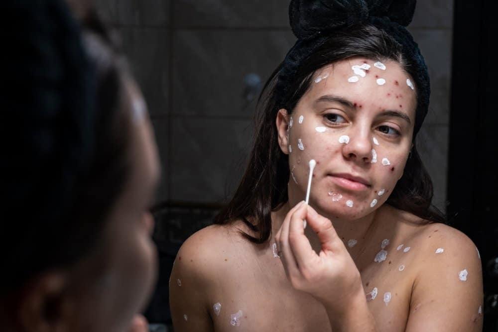 Sẹo lõm thủy đậu có chữa được không?