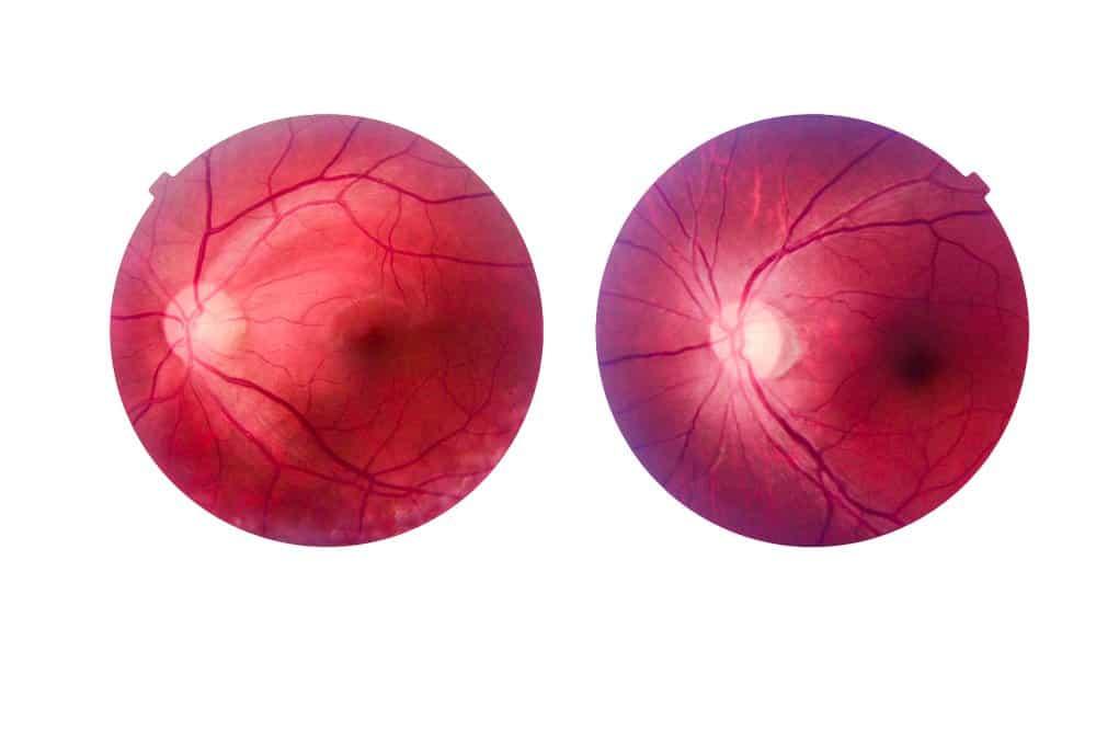 Thoái hóa võng mạc là gì? Hiểu để ngăn ngừa mất thị lực