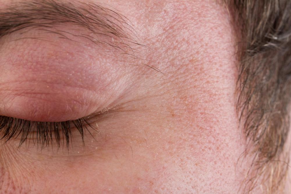 Nhận biết triệu chứng đau mắt hột theo từng giai đoạn