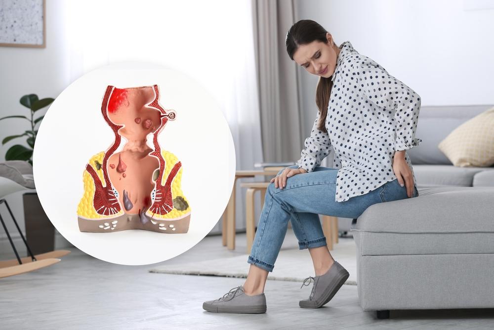 Bệnh trĩ có tự khỏi không? Tình trạng này thường kéo dài bao lâu?