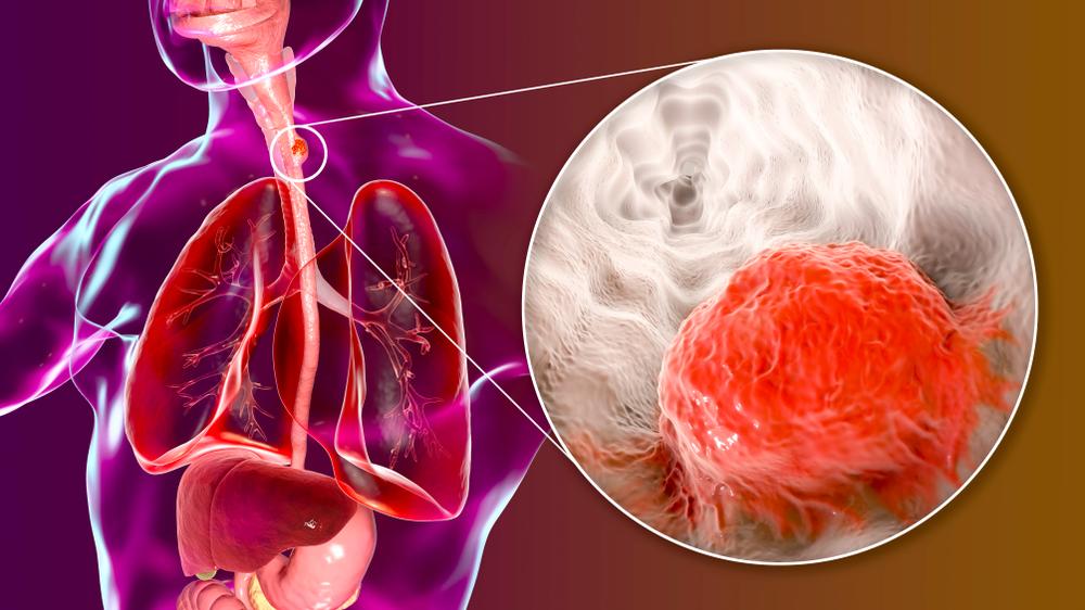 Ung thư thực quản giai đoạn 3: Điều trị và tiên lượng