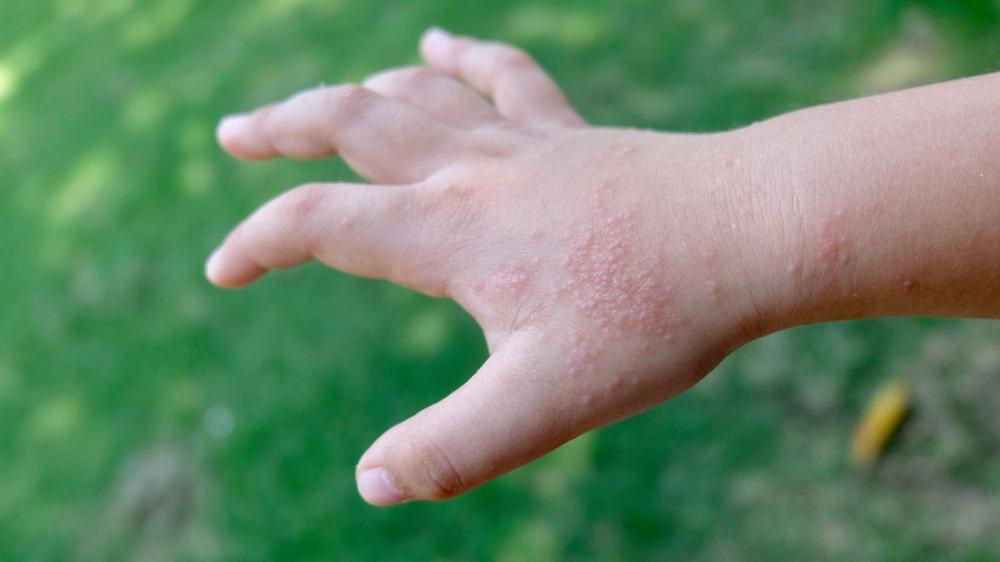 Giải đáp thắc mắc: Bệnh tổ đỉa có lây không?