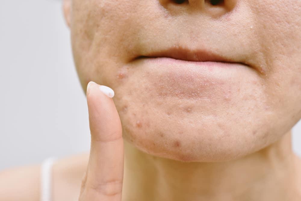 Hiểu rõ về các loại thuốc trị mụn để sử dụng đúng cách!