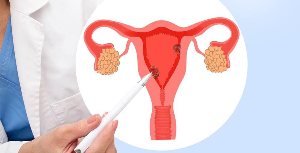 bi-polyp-co-tu-cung-co-quan-he-duoc-khong