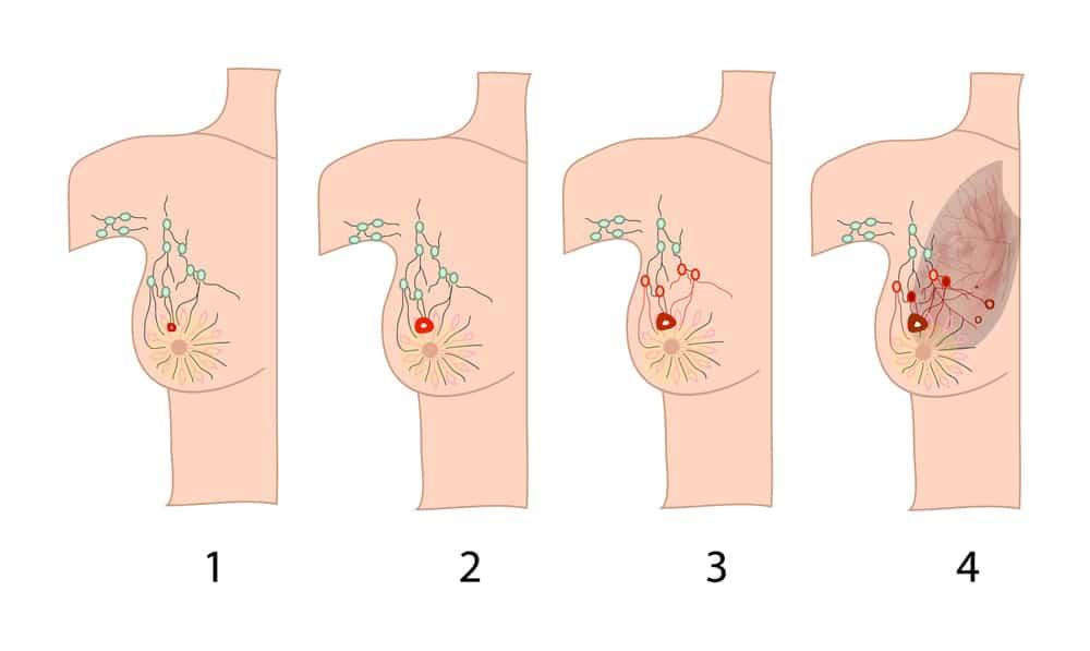 ung-thu-vu-giai-doan-dau