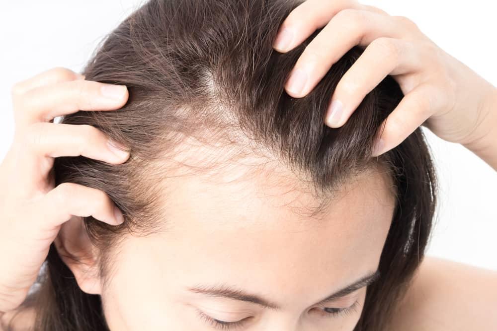 Tóc rụng nhiều ở nữ phải làm sao? Điều trị và chăm sóc thế nào?