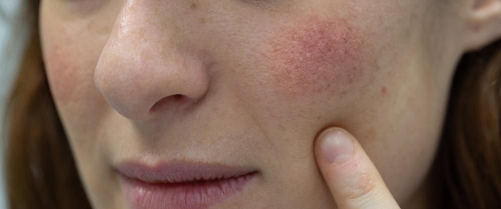 Viêm da tiết bã ở mặt: Nguyên nhân và cách điều trị