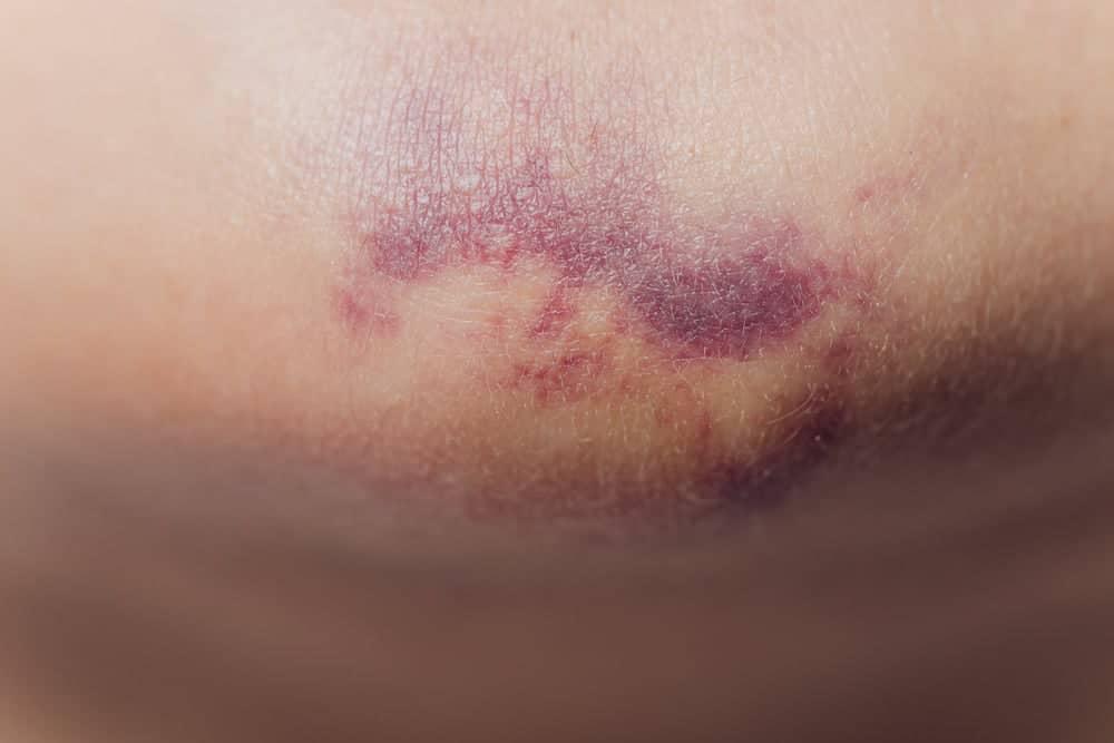 Vỡ mạch máu dưới da là bệnh gì? Nguyên nhân & cách xử lý