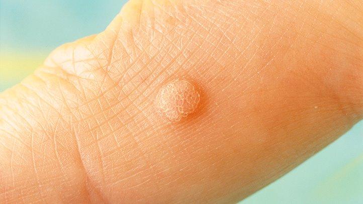 Các phương pháp đốt mụn cóc hiệu quả bạn nên biết