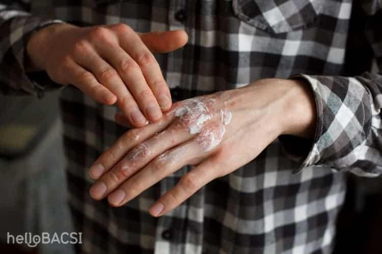 Lác đồng tiền có tự khỏi không? Cách điều trị hắc lào an toàn