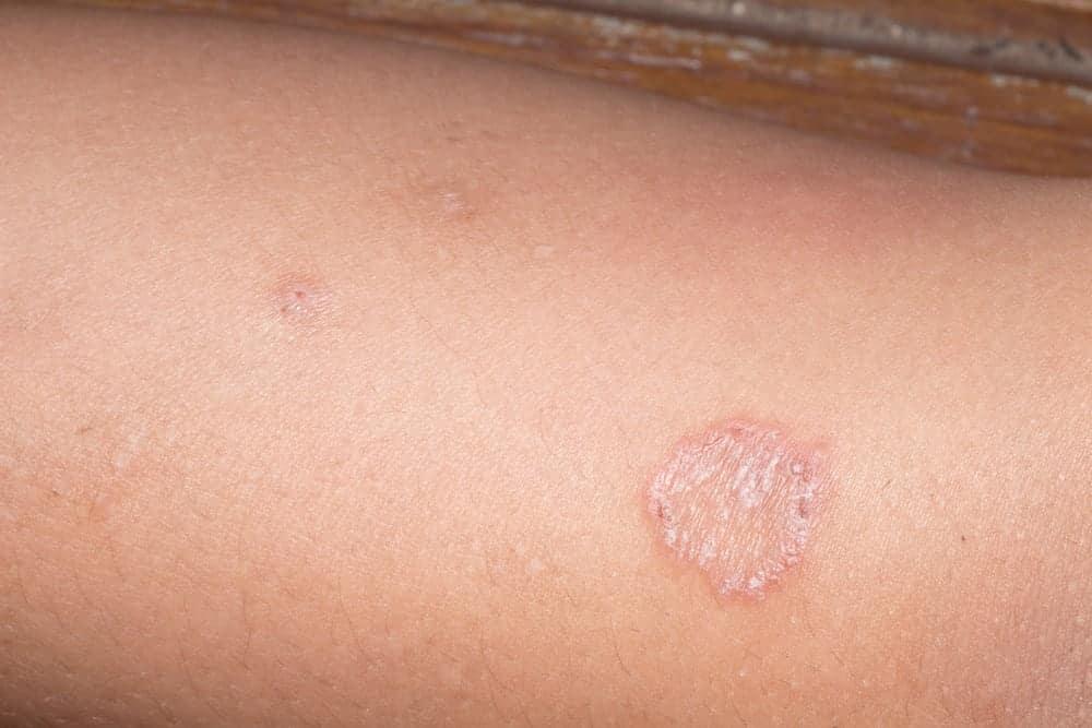 Nấm da không ngứa là dấu hiệu bệnh da liễu nào?