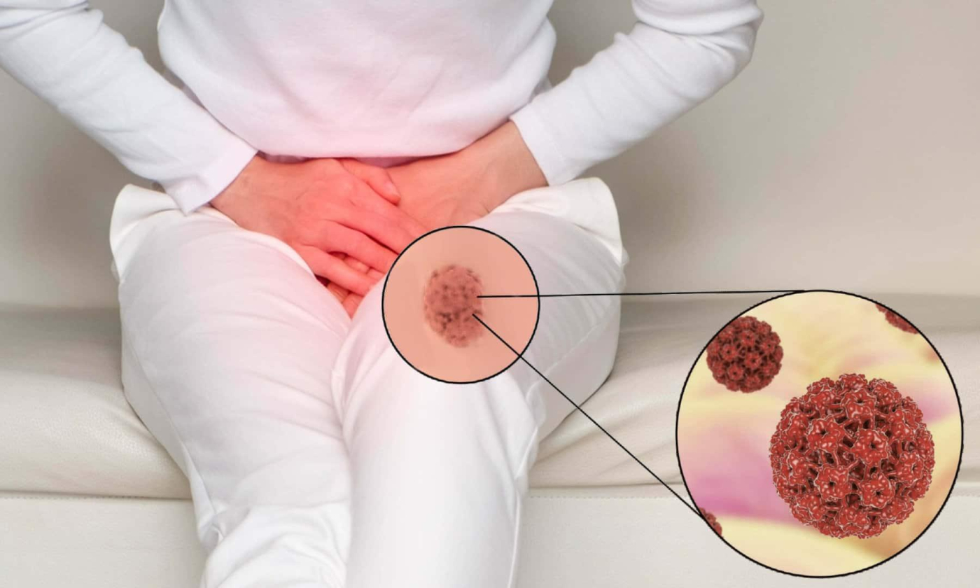 Bạn nên làm gì khi phát hiện dấu hiệu sùi mào gà ở nữ?