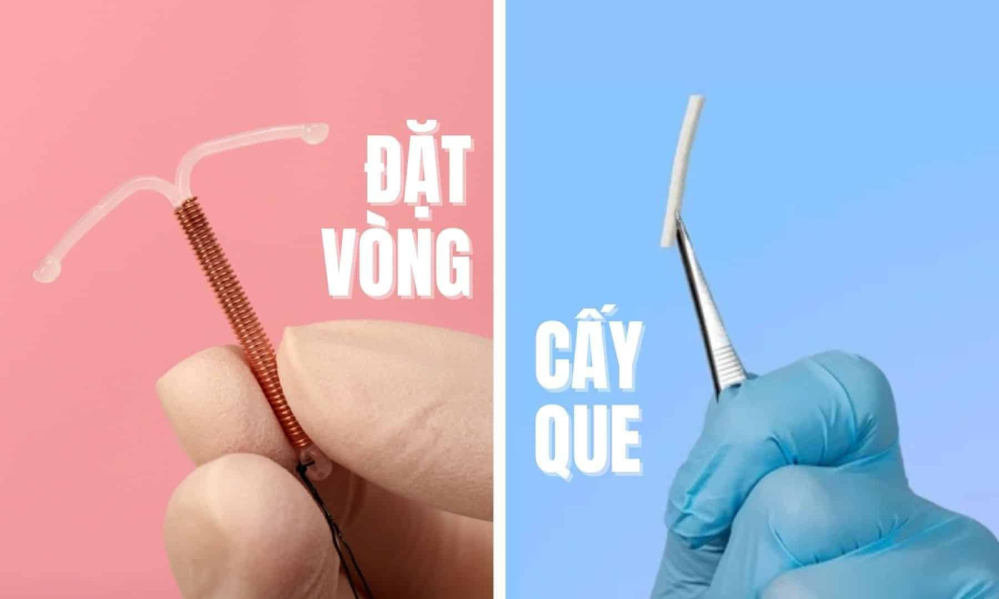 Nên đặt vòng hay cấy que tránh thai? Ưu nhược điểm của từng loại