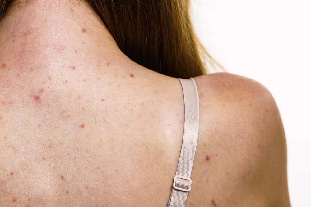 Top 5 xà phòng trị mụn lưng bạn nên thử