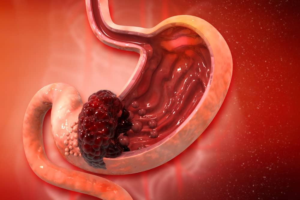 Ung thư dạ dày giai đoạn 2 (II): Điều trị và tiên lượng