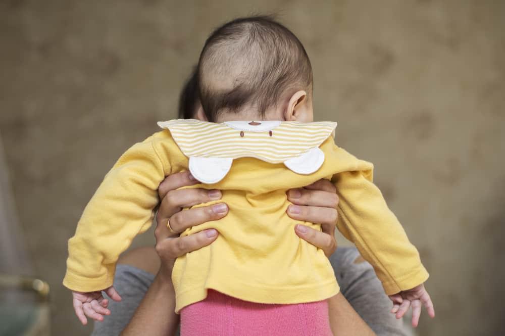 Rụng tóc vành khăn ở trẻ nhỏ là gì, trẻ có nguy cơ hói vĩnh viễn không?