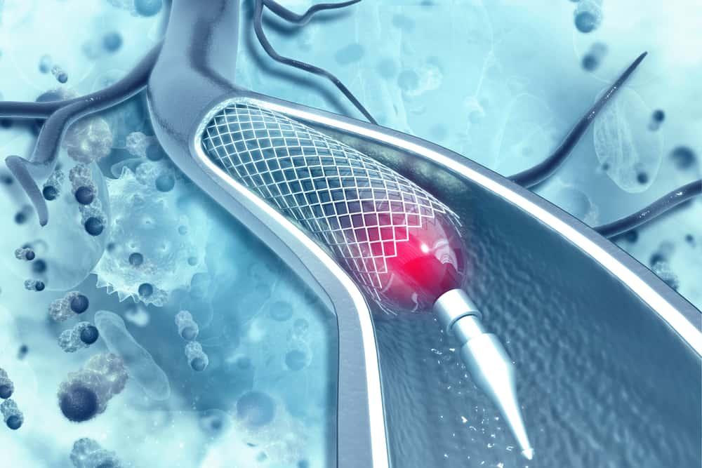 dat-stent