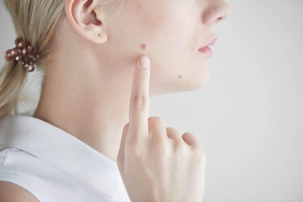 Tẩy nốt ruồi kiêng ăn gì và kiêng trong bao lâu để hạn chế sẹo?