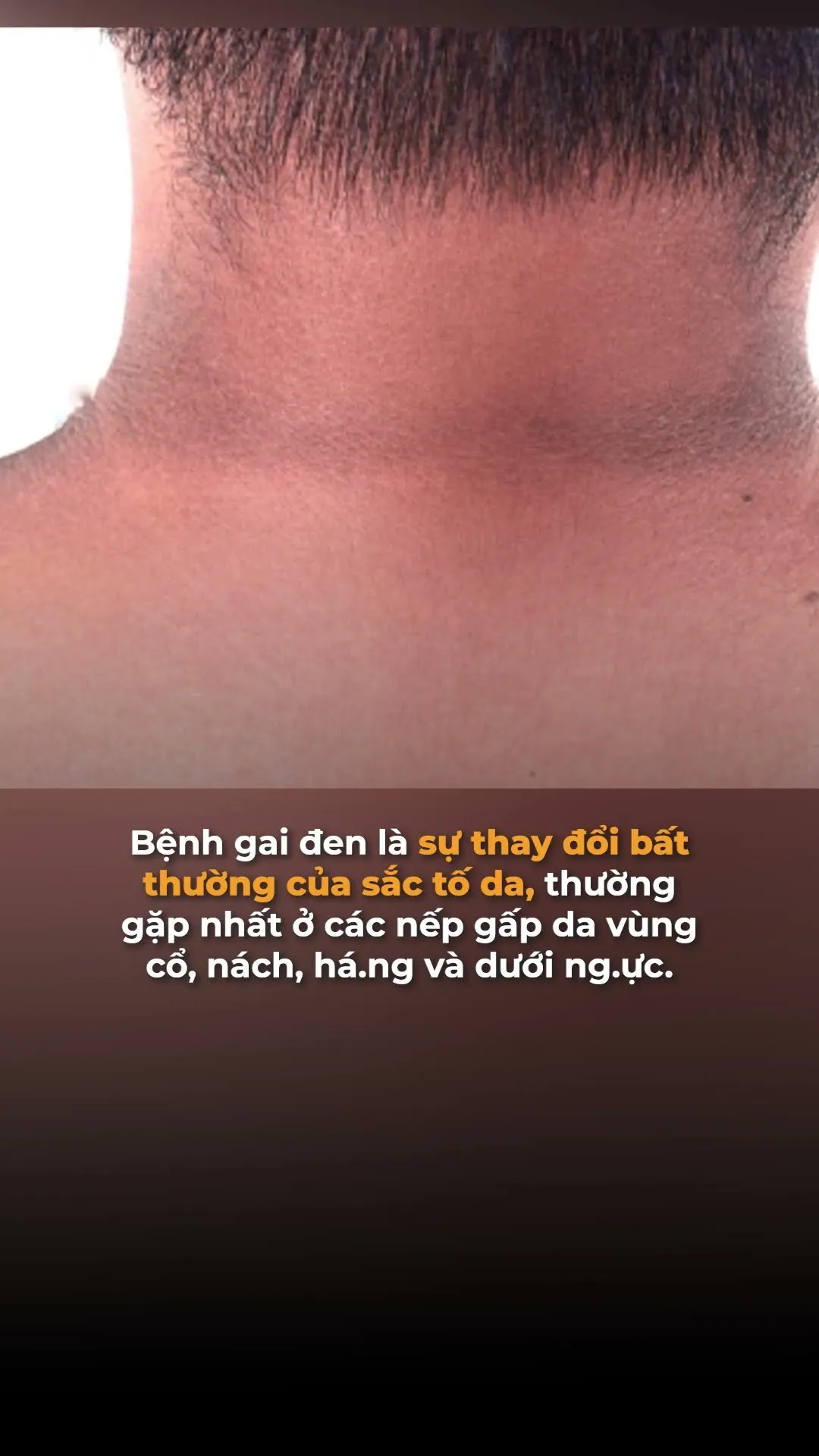 Dấu hiệu của tiểu đường nhưng nhiều người thường bỏ qua