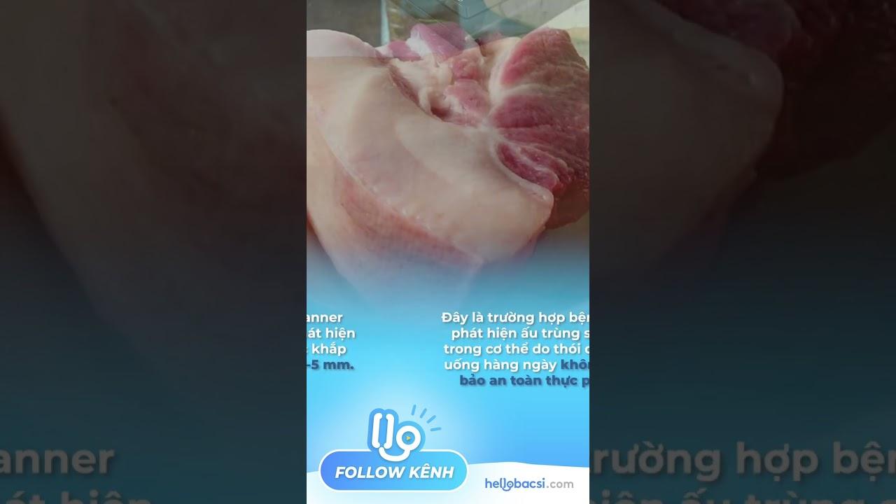 Đi khám do đau bụng, bất ngờ phát hiện sán ký sinh!