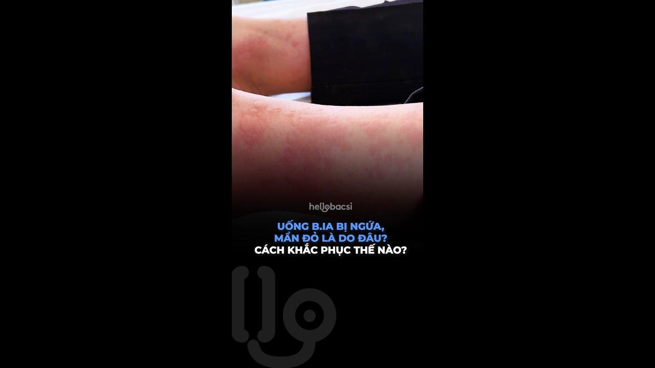 Uống bia bị ngứa, mẩn đỏ là do đâu Cách khắc phục thế nào